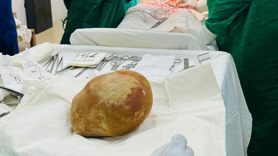 Sri Lankan Doctors Remove Record-Busting 3.1kg Bladder Stone
